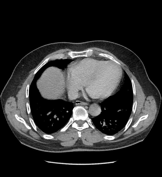 Chromophobe renal cell carcinoma (Radiopaedia 86879-103083 D 1).jpg