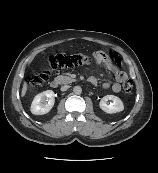 Chromophobe renal cell carcinoma (Radiopaedia 86879-103083 D 60).jpg