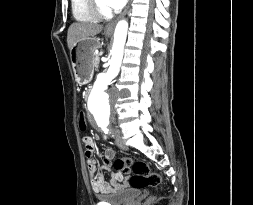 Chronic contained rupture of abdominal aortic aneurysm with extensive erosion of the vertebral bodies (Radiopaedia 55450-61901 B 36).jpg