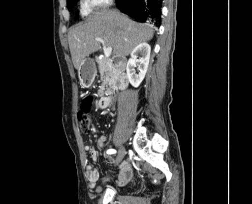 Chronic contained rupture of abdominal aortic aneurysm with extensive erosion of the vertebral bodies (Radiopaedia 55450-61901 B 7).jpg