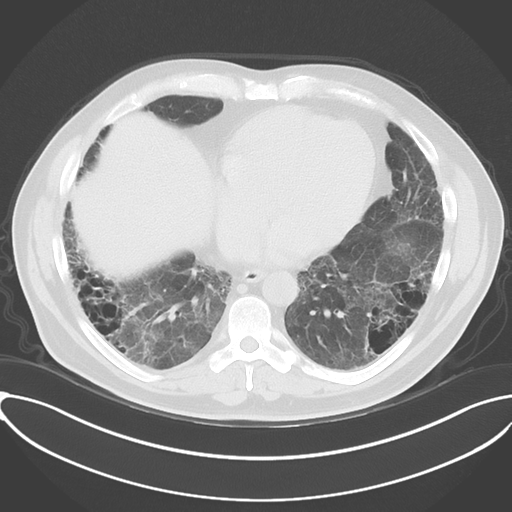 Chronic hypersensitivity pneumonitis (Radiopaedia 48107-52922 Axial lung window 42).png
