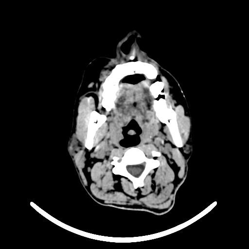 Chronic invasive fungal sinusitis with intraorbital and intracranial extension (Radiopaedia 56387-63046 Axial non-contrast 4).jpg