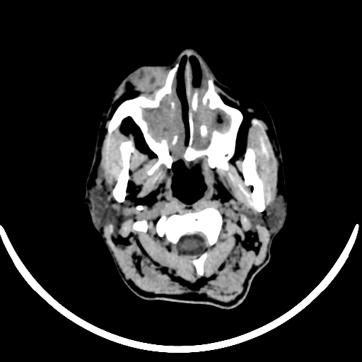 File:Chronic invasive fungal sinusitis with intraorbital and intracranial extension (Radiopaedia 56387-63046 Axial non-contrast 50).jpg