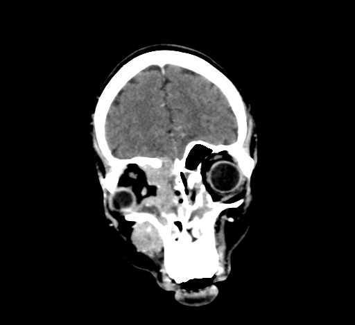 Chronic invasive fungal sinusitis with intraorbital and intracranial extension (Radiopaedia 56387-63046 C 83).jpg