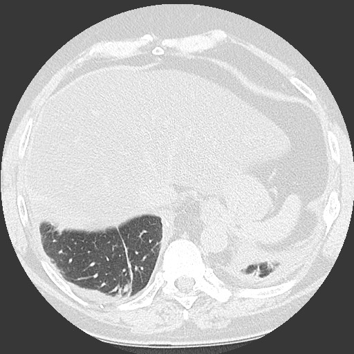 File:Chronic lung allograft dysfunction - restrictive form (Radiopaedia 60595-68316 Axial lung window 60).jpg