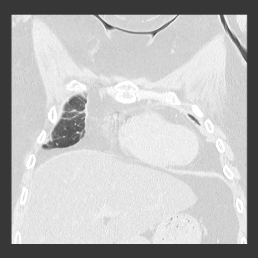 File:Chronic lung allograft dysfunction - restrictive form (Radiopaedia 60595-68316 Coronal lung window 31).jpg