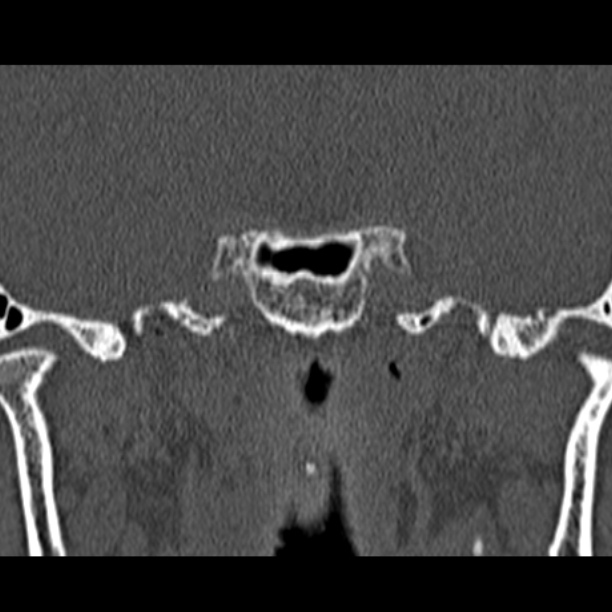 Chronic maxillary sinusitis (Radiopaedia 27879-28116 Coronal bone window 56).jpg