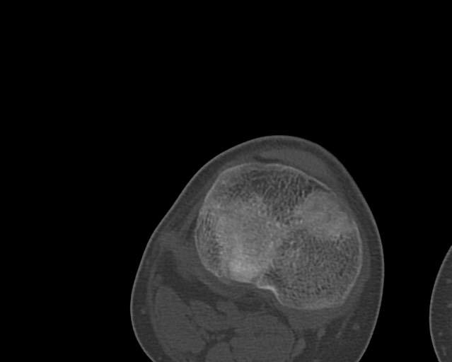 Chronic ostemyelitis of the femur with long sinus tract (Radiopaedia 74947-85982 Axial bone window 237).jpg