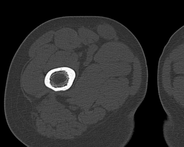 Chronic ostemyelitis of the femur with long sinus tract (Radiopaedia 74947-85982 Axial bone window 39).jpg