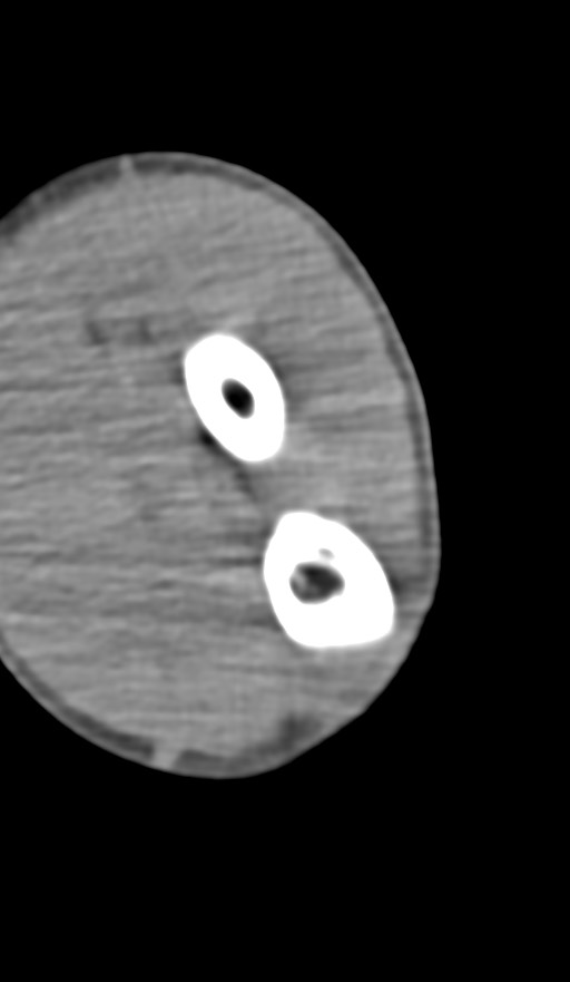 Chronic osteomyelitis of the distal humerus (Radiopaedia 78351-90971 Axial non-contrast 117).jpg