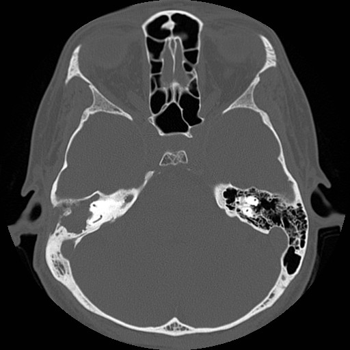 File:Chronic otomastoiditis (Radiopaedia 27138-27309 Axial bone window 42).jpg