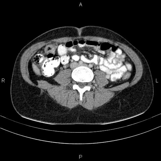 File:Chronic pancreatitis (Radiopaedia 64576-73450 C 102).jpg