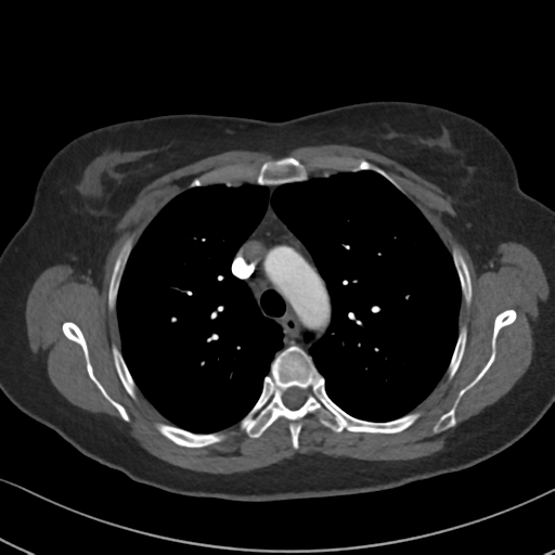 File:Chronic pulmonary embolus (Radiopaedia 39129-41341 Axial C+ CTPA 33).png