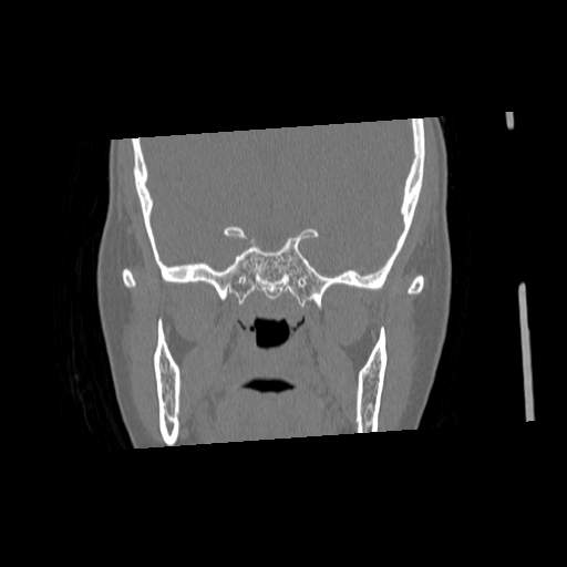 File:Chronic sinusitis with intra-sinus calcification (Radiopaedia 63919-72668 Coronal bone window 21).jpg