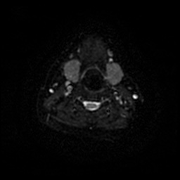 Chronic submandibular sialadenitis (Radiopaedia 61852-69885 Axial DWI 47).jpg