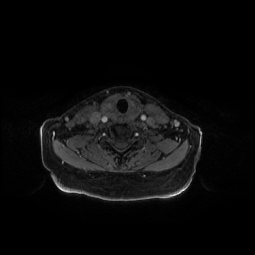 Chronic submandibular sialadenitis (Radiopaedia 61852-69885 Axial T1 C+ fat sat 12).jpg
