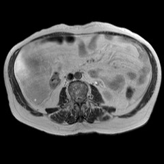 File:Cirrhosis and hepatocellular carcinoma in the setting of hemochromatosis (Radiopaedia 75394-86594 Axial T2 2).jpg