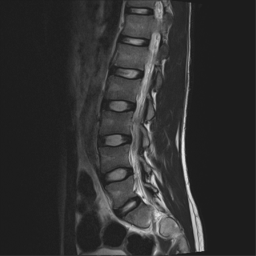 File:Clear cell meningoma - lumbar spine (Radiopaedia 60116-67690 Sagittal T2 6).png