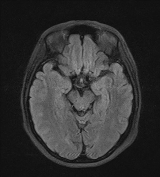 File:Clival meningioma (Radiopaedia 53278-59248 Axial FLAIR 10).jpg