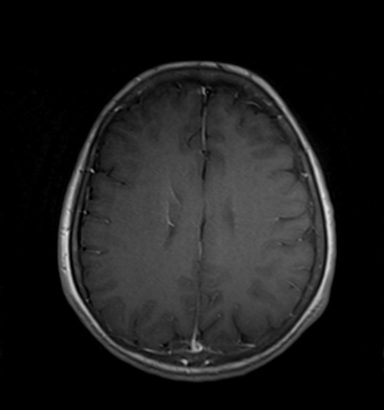 File:Clival meningioma (Radiopaedia 53278-59248 Axial T1 C+ 16).jpg