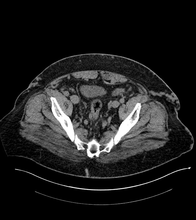 Closed-loop small bowel obstruction-internal hernia (Radiopaedia 78439-91096 Axial non-contrast 131).jpg
