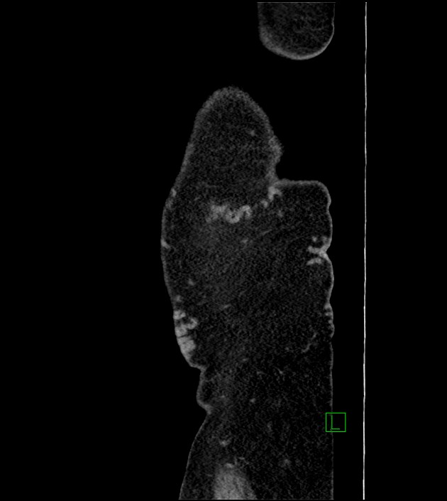 Closed-loop small bowel obstruction-internal hernia (Radiopaedia 78439-91096 C 139).jpg