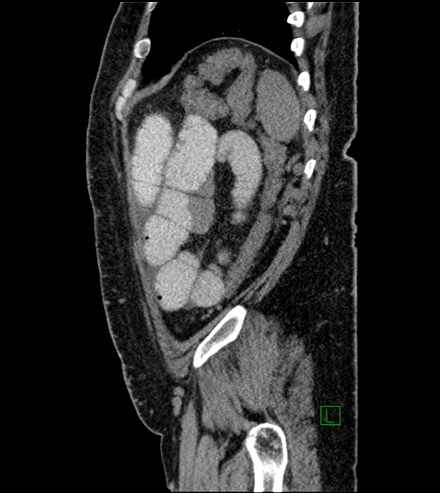 Closed-loop small bowel obstruction-internal hernia (Radiopaedia 78439-91096 C 32).jpg