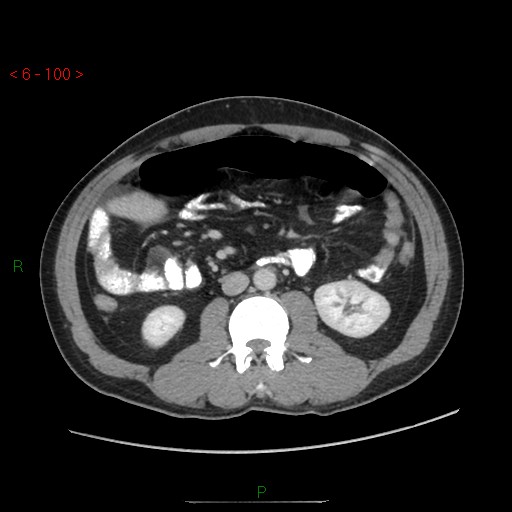 File:Closed loop obstruction and appendicular stump mucocele (Radiopaedia 54014-60163 A 55).jpg