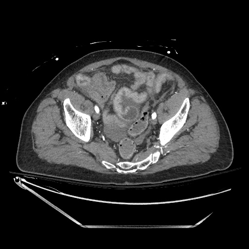 File:Closed loop obstruction due to adhesive band, resulting in small bowel ischemia and resection (Radiopaedia 83835-99023 B 129).jpg