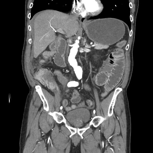 Closed loop obstruction due to adhesive band, resulting in small bowel ischemia and resection (Radiopaedia 83835-99023 C 61).jpg