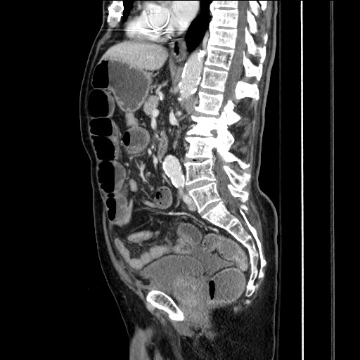 File:Closed loop obstruction due to adhesive band, resulting in small bowel ischemia and resection (Radiopaedia 83835-99023 F 101).jpg