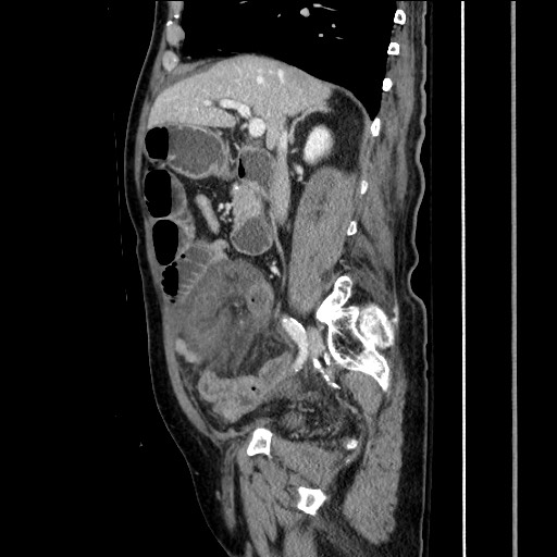 Closed loop obstruction due to adhesive band, resulting in small bowel ischemia and resection (Radiopaedia 83835-99023 F 78).jpg