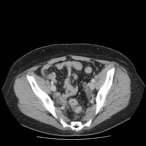 File:Closed loop small bowel obstruction (Radiopaedia 65403-74451 A 66).jpg
