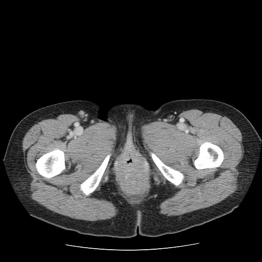 File:Closed loop small bowel obstruction (Radiopaedia 65403-74451 Axial 80).jpg