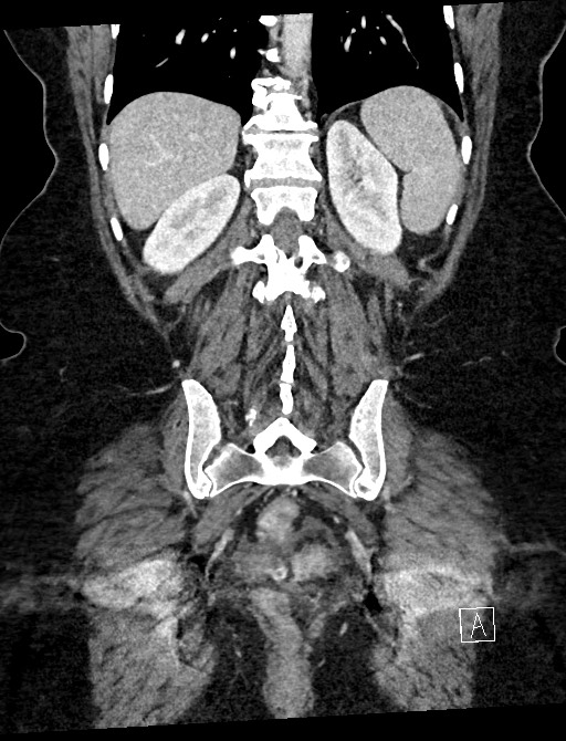 Closed loop small bowel obstruction - adhesions (Radiopaedia 59078-66369 B 93).jpg