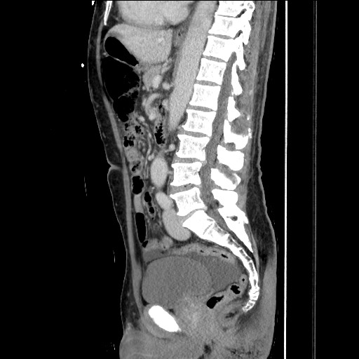 Closed loop small bowel obstruction - omental adhesion causing "internal hernia" (Radiopaedia 85129-100682 C 97).jpg