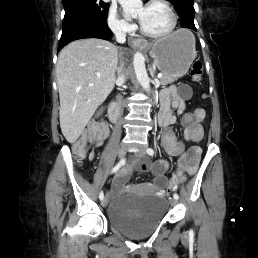 File:Closed loop small bowel obstruction due to adhesive band, with intramural hemorrhage and ischemia (Radiopaedia 83831-99017 C 63).jpg