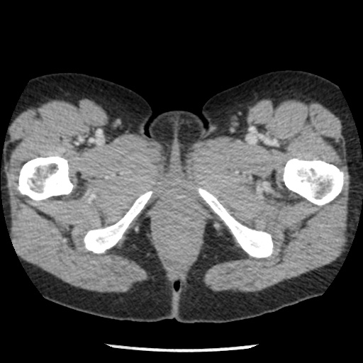 Closed loop small bowel obstruction due to trans-omental herniation (Radiopaedia 35593-37109 A 92).jpg