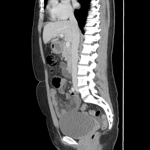 Closed loop small bowel obstruction due to trans-omental herniation (Radiopaedia 35593-37109 C 31).jpg