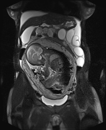 File:Closed loop small bowel obstruction in pregnancy (MRI) (Radiopaedia 87637-104031 Coronal T2 fat sat 24).jpg