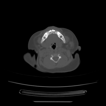 Cloverleaf skull (Radiopaedia 91901-109710 Axial bone window 25).jpg