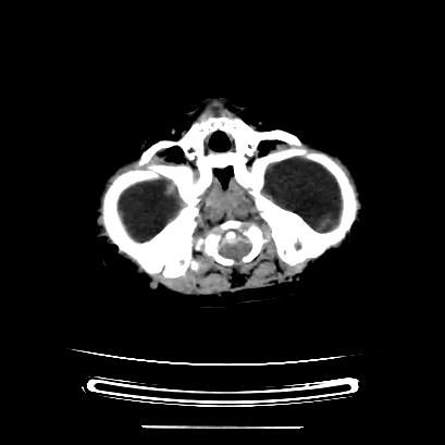 Cloverleaf skull (Radiopaedia 91901-109710 Axial non-contrast 44).jpg
