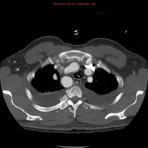 File:Coarctation of the aorta (Radiopaedia 8681-9490 B 16).jpg