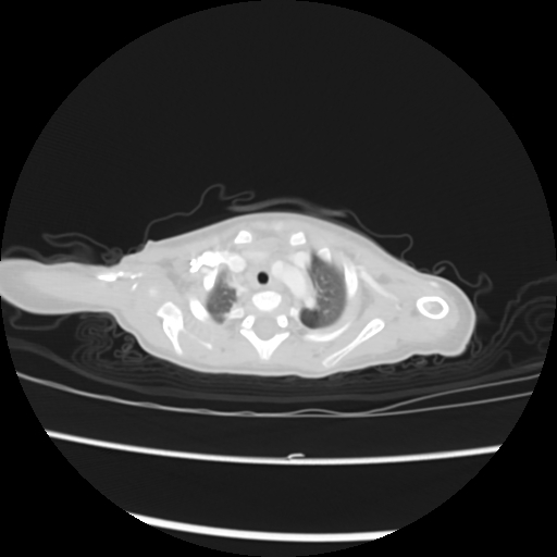 Coarctation of the aorta and patent ductus arteriosus (Radiopaedia 68033-77499 Axial lung window 3).jpg