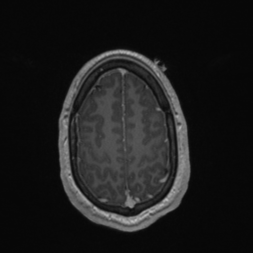 File:Colloid cyst (Radiopaedia 44510-48181 Axial T1 C+ 152).png