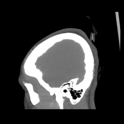 Colloid cyst (resulting in death) (Radiopaedia 33423-34499 B 7).png