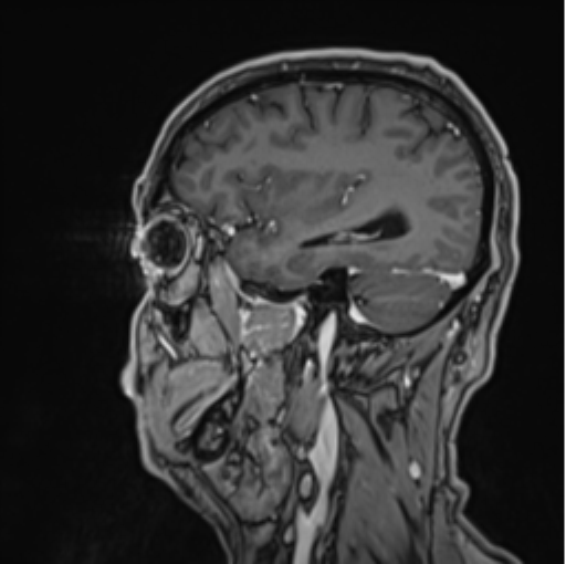 File:Colloid cyst of the third ventricle (Radiopaedia 86571-102662 Sagittal T1 C+ 58).png