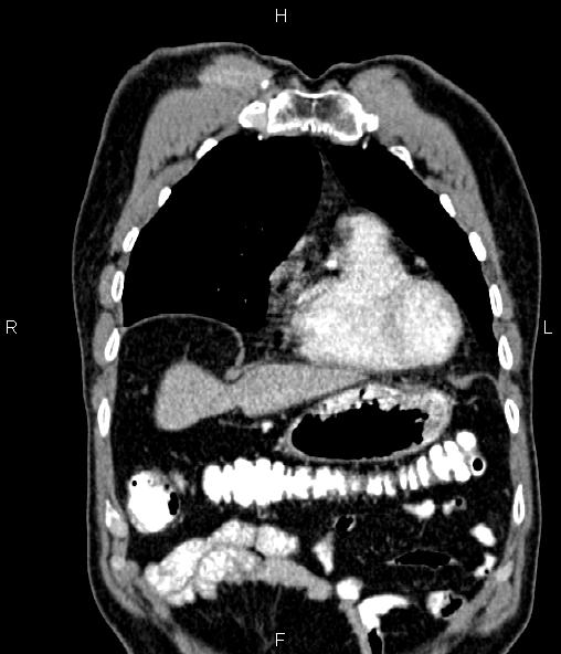 Colon adenocarcinoma (Radiopaedia 83266-97671 C 15).jpg