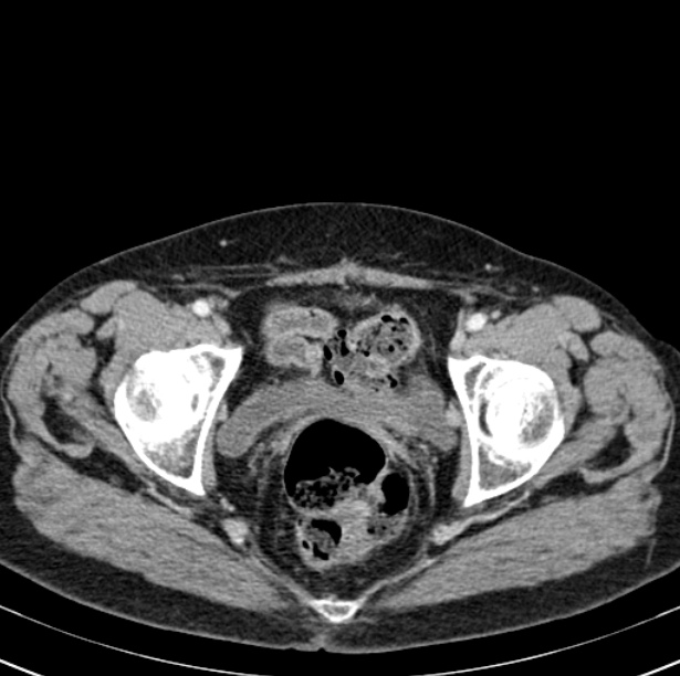 Colon carcinoma with hepatic metastases (Radiopaedia 29477-29961 A 106).jpg