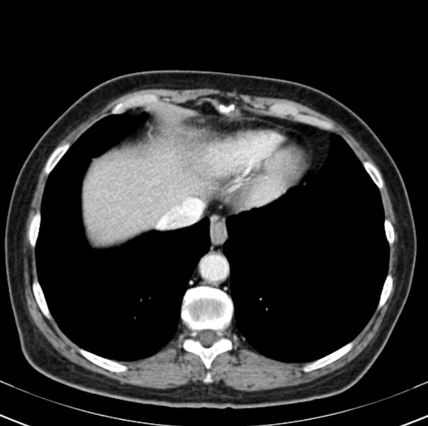 Colon carcinoma with hepatic metastases (Radiopaedia 29477-29961 A 11).jpg